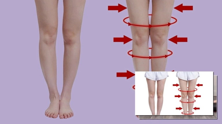 Bí quyết chữa chân vòng kiềng cho người lớn tại nhà hiệu quả