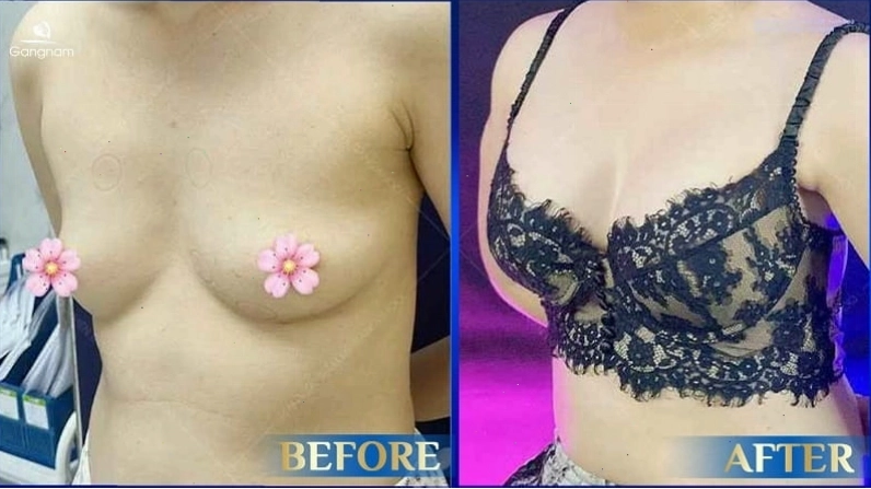 Các loại áo ngực hỗ trợ thu hẹp khe ngực