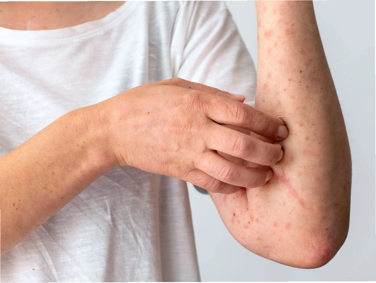 Cơ địa nhạy cảm là tiền đề của các phản ứng dị ứng