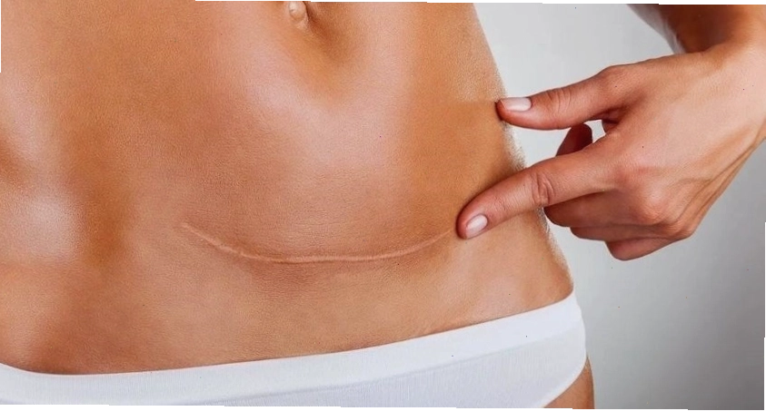 Đeo đai nịt bụng có thể hỗ trợ giảm đau khi di chuyển cho mẹ sau sinh mổ