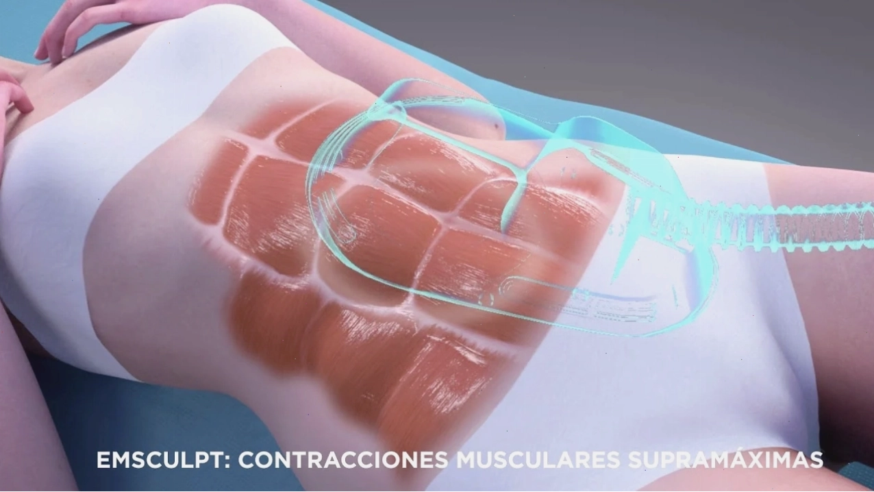 Máy Emsculpt điều trị vùng bụng