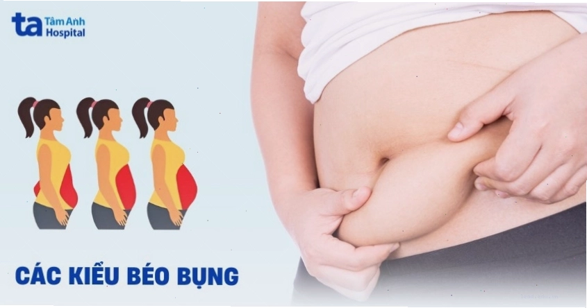 Minh họa các kiểu béo bụng khác nhau ở nữ giới