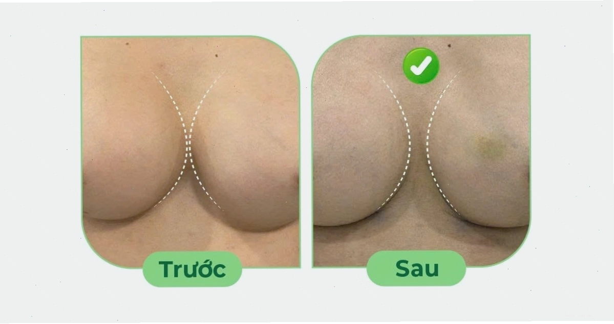 Phẫu thuật chỉnh sửa ngực hỏng