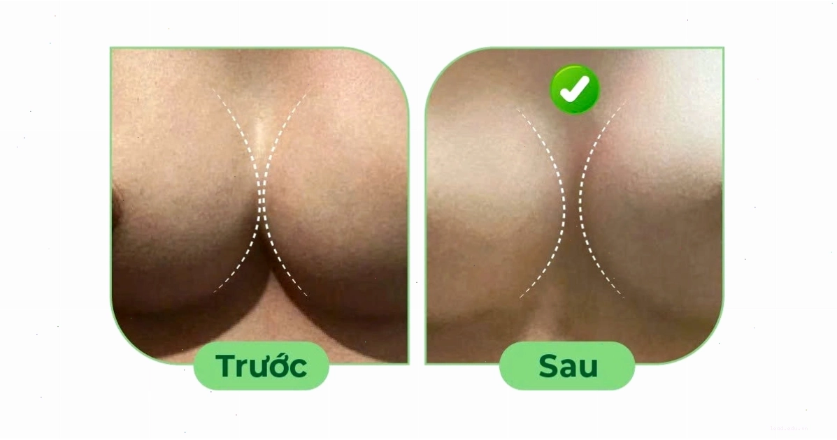 Tình trạng ngực thông khe sau nâng ngực